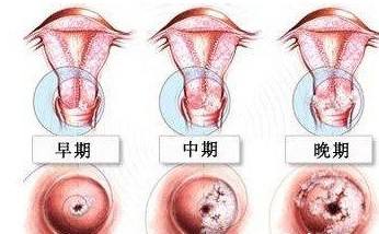 宫颈息肉有哪些症状呢?(图1)